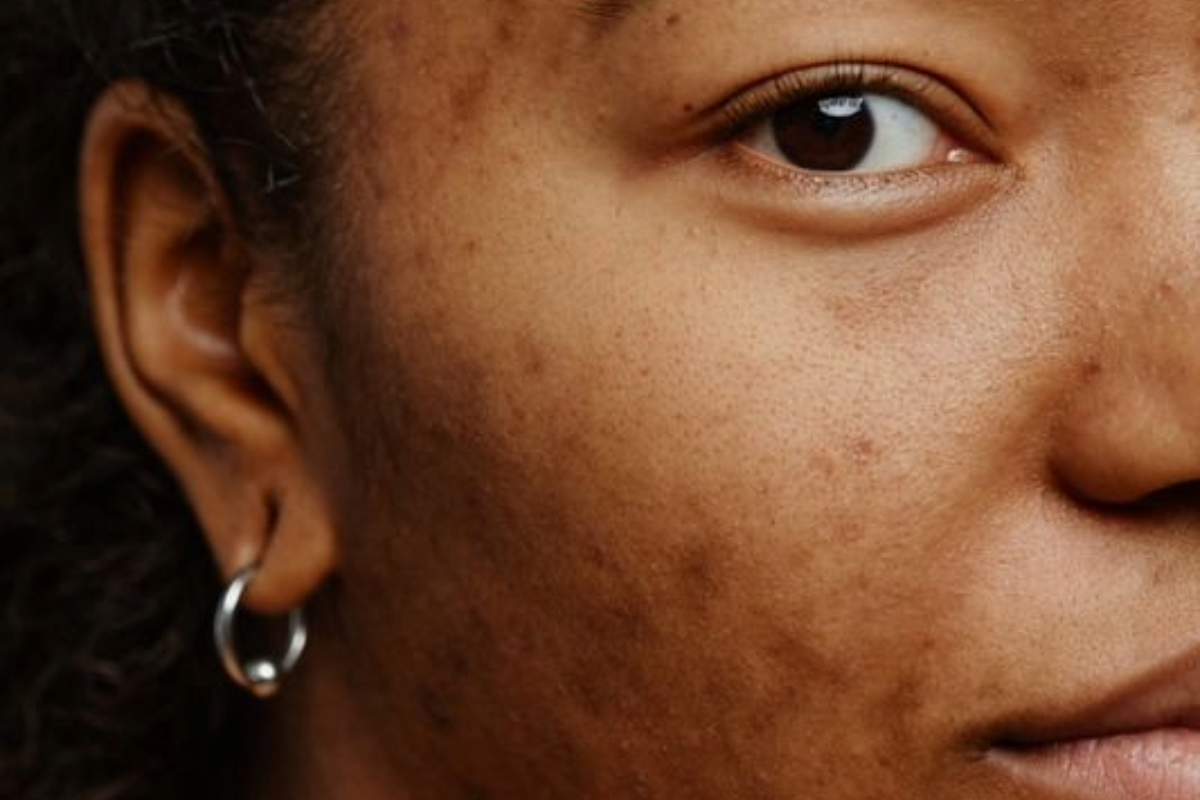 Sun Damage / Photo-Pigmentation